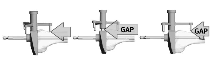 Zimmer MOST Options System Surgical Technique 29 Femoral Sizing a Guide b c Trial Stem Adapter Correct Sizing Under Sized Over Sized Fig.