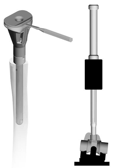 32 Zimmer MOST Options System Surgical Technique Component Selection and Assembly When cementing a femoral stem, downsize at least one stem diameter (2mm) to allow for an adequate cement mantle.