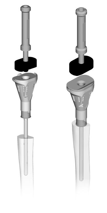 34 Zimmer MOST Options System Surgical Technique Component Implantation Implantation of the Distal Femoral Component Cement is applied to the hinged femur, femoral stem and canal.