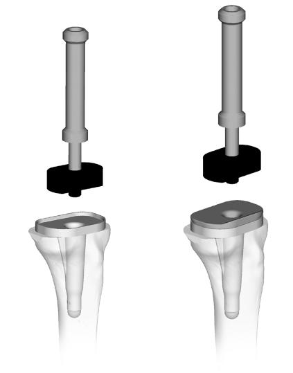 50 Zimmer MOST Options System Surgical Technique Component Implantation Implantation of the Metal- Backed Hinged Tibial Component Cement is applied to the undersurface of the tibial baseplate, keel