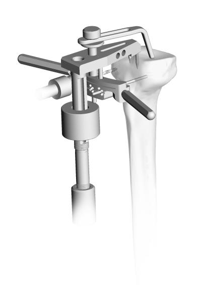 Zimmer MOST Options System Surgical Technique 57 Zero Degree Tibial Slope A zero degree tibial cut is recommended to accommodate the cone of the hinged tibial baseplate into the tibia.