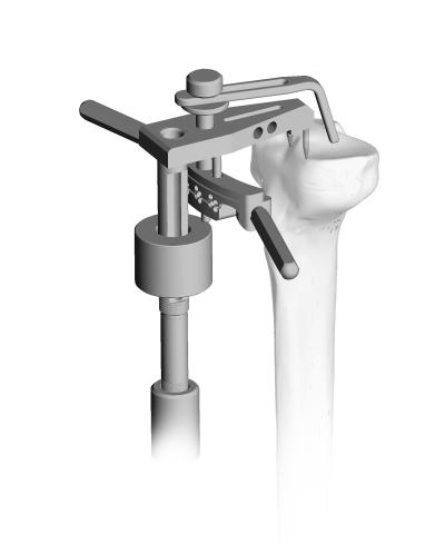 Tibial Stylus Appendix A Level of Resection Use the 10mm Tibial Stylus to determine the Tibial Saw Guide position for minimal resection of the proximal tibia (Fig. 98).