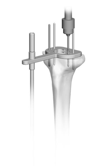 Zimmer MOST Options System Surgical Technique 59 Proximal Tibial Sizing and Drilling To avoid soft tissue impingement, select the appropriate size Tibial Baseplate Sizer/Reamer Guide that best fills
