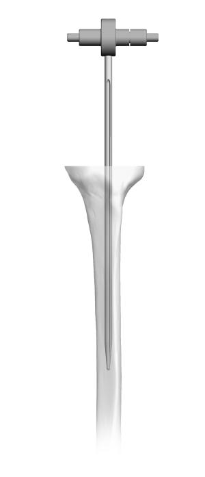 Zimmer MOST Options System Surgical Technique 61 Intramedullary Tibial Option 2 only Reference Hole While Using a 8mm I/M Rod Attach the 8mm (5/16 ) I/M rod to the Quick Disconnect Handle.