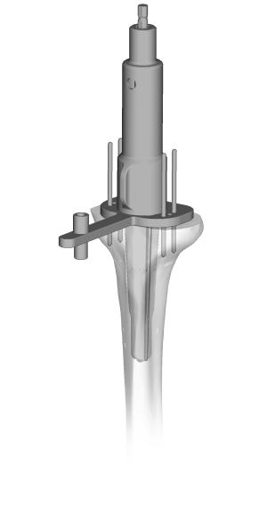 Zimmer MOST Options System Surgical Technique 65 Assemble the Primary Cone Reamer to the Cone Reamer Guide (Fig. 113).