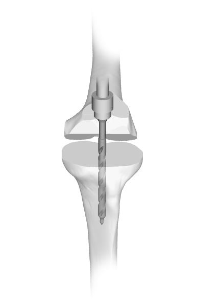 Zimmer MOST Options System Surgical Technique 67 Appendix C Intramedullary Tibial Option Metal-backed tibia with a long stem Tibial Preparation Tibial Medullary Canal Preparation Direct vertical