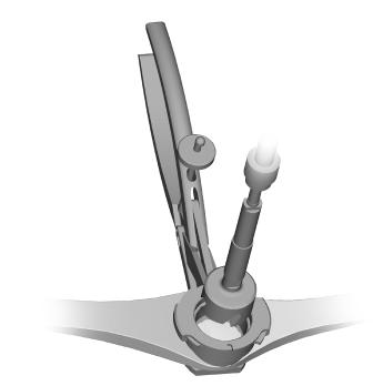The reamer is used if additional bone resection or countersinking is desired (Fig. 132).