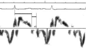 680 De Marchi, Allemann, Seiler Figure 1 Example of a Doppler tissue velocity tracing at a septal basal myocardial region in a patient with hypertensive heart disease: (1), the time from the ECG R