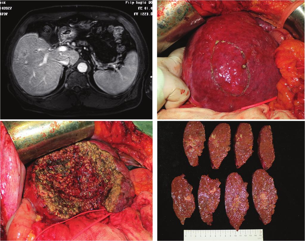 Medicine Yan et al Volume 95, Number 19, May 2016 FIGURE 1. Anatomic liver S5 resection. Infiltrative small HCC lesion.