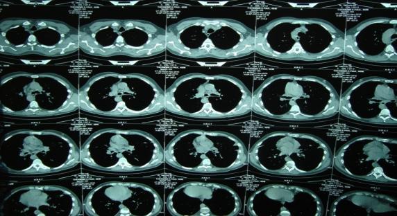 both lungs with bilateral lower and right middle lobe bronchiectasis. HRCT scan of lungs shows bronchiectasis changes.
