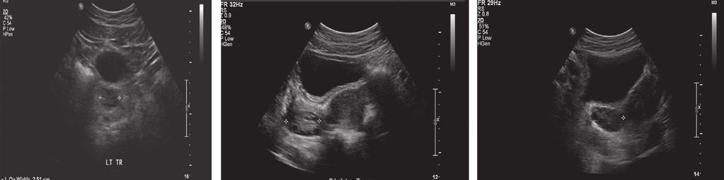 Senaldi et al.: Ultrasonography use in adolescents with PCOS 609 (8, 12). In addition, there was a statistically significant difference in the S/A ratio between patients with PCOS vs.