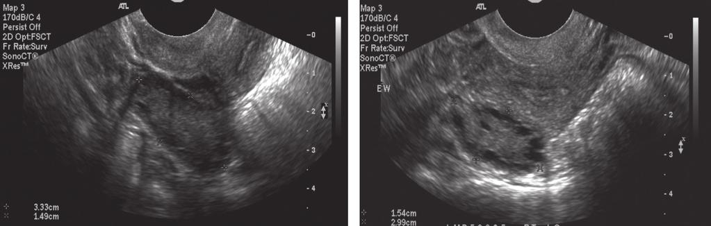 610 Senaldi et al.: Ultrasonography use in adolescents with PCOS A B Figure 2 (A) Transabdominal longitudinal ultrasound image of the right ovary in an overweight adolescent with PCOS.