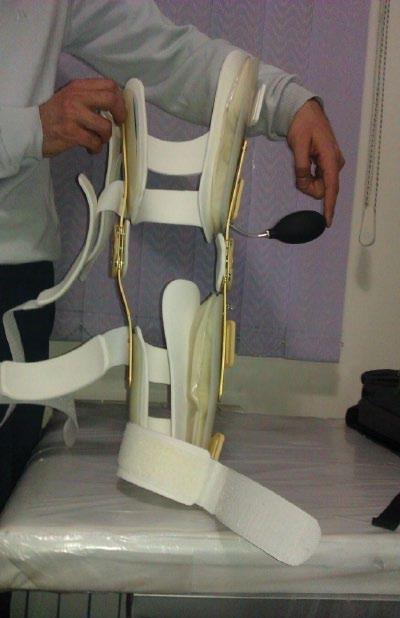 382 Prosthetics and Orthotics International 38(5) Resultant bial rota on Figure 2. The custom-fitted knee unloader orthosis used in this study. being cumbersome.
