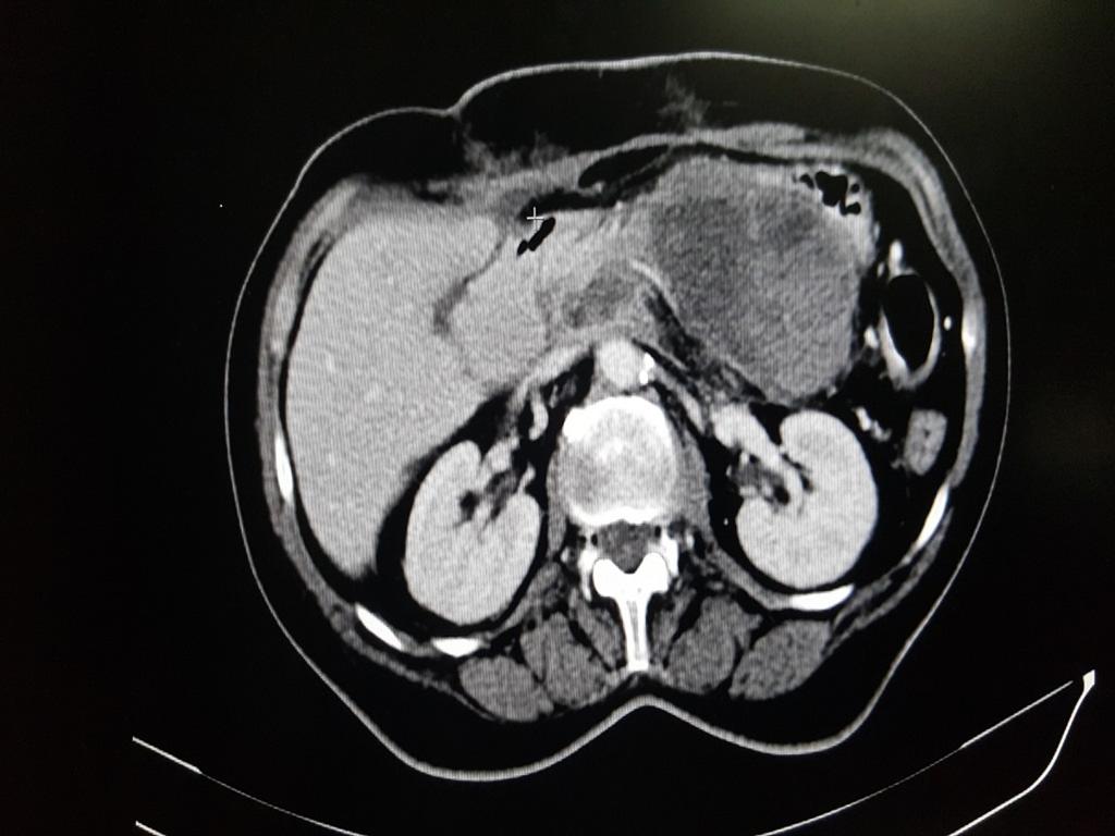 The most common local complication was ascites and peripancreatic fluid and the systemic one was pleural effusion.