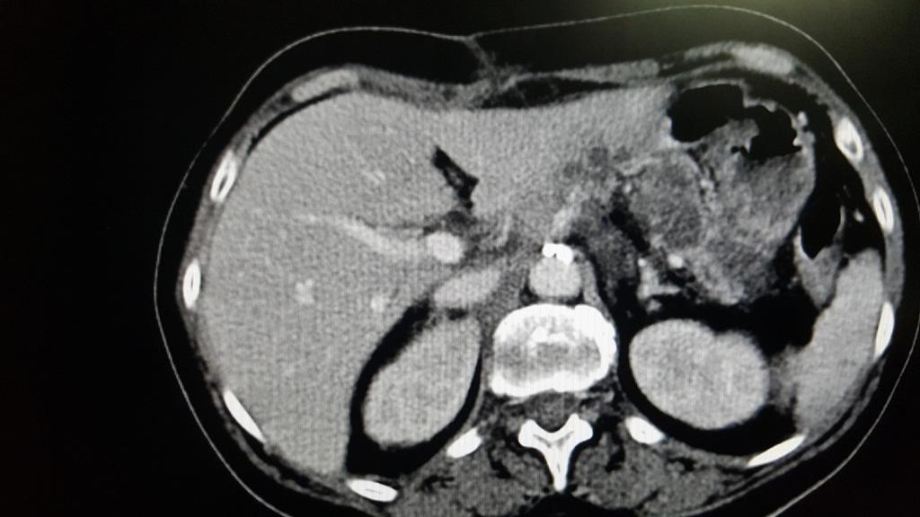 Fig. 3: Contrast-enhanced CT scan of the upper abdomen showing peripancreatic non-enhancing areas of necrosis of the pancreas