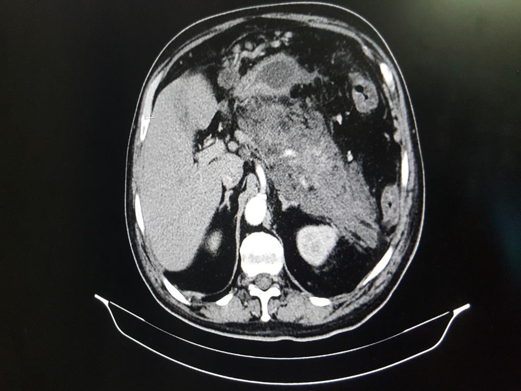 Fig. 4: Contrast-enhanced CT scan of the upper abdomen showing peripancreatic and retro peritoneal edema. Large non-enhancing areas of necrosis are visible in the body and tail of the pancreas.