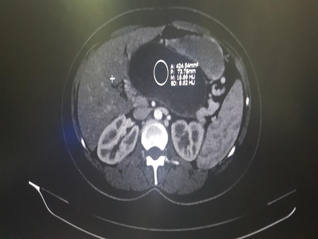 Fig. 5: Contrast-enhanced CT scan of the upper abdomen showing a well-defined fluid collection in the retroperitoneum, just below the level of the pancreas consisting with pancreatic pseudocyst.