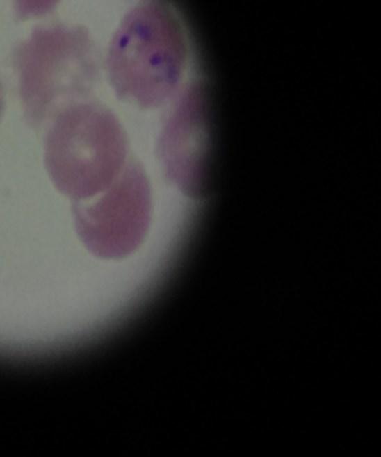 The protozoan is illustrated by dark blue spots appearing in the RBCs. Figure 4 shows a microscopic view of a slide showing infected RBCs with malaria.