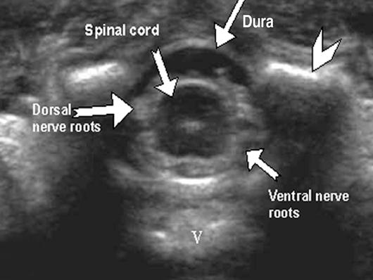 Sonography of Neonatal Spine Neural crest Downloaded from www.ajronline.org by 46.3.195.60 on 02/04/18 from IP address 46.3.195.60. Copyright RRS.