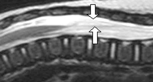 lso note prominent echogenic central spinal canal (arrowhead), a normal variant seen in some children. Fig.