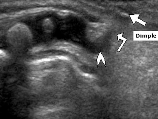 8 Pseudosinus tract in 12-day-old infant with dimple in gluteal crease.