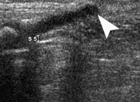 , Longitudinal sonogram of coccyx in 2-week-old girl shows hypoechoic cartilaginous tip (arrowheads), which is acutely angulated dorsally as it extends toward skin surface.