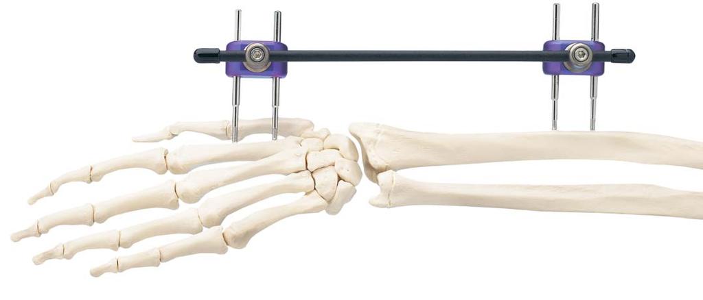 Low-Profile Wrist Fixator Indications Intended for stabilization of fractures of the distal radius.