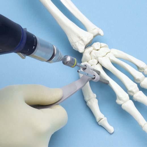 Low-Profile Wrist Fixator Technique Overview 1 Insert distal Schanz screws To avoid entrapping the extensor mechanism in extension, flex the second metacarpophalangeal joint to 90.