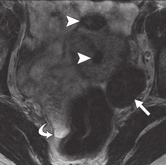 Shinagare et al. Fig. 1 52-year-old woman with left ovarian fibroma.