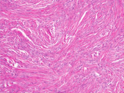 enhancing (maximum percentage enhancement, 118%) uterine fibroid (arrowhead). D, H and E stained slide of fibroma shows bland spindle cells arranged in fascicles and set within collagenous stroma.