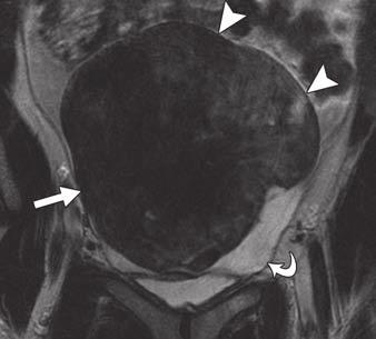 Shinagare et al. sents a pseudocapsule (Fig. 2 and 3). A true fibrous capsule was present in only one case. Degenerative changes noted on MRI consisted of ischemic or edematous changes (Fig. 4).