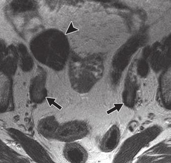 This again correlates with the normal ovarian stroma stretched around the fibromas and fibrothecomas, sometimes seen on MRI as a pseudocapsule.