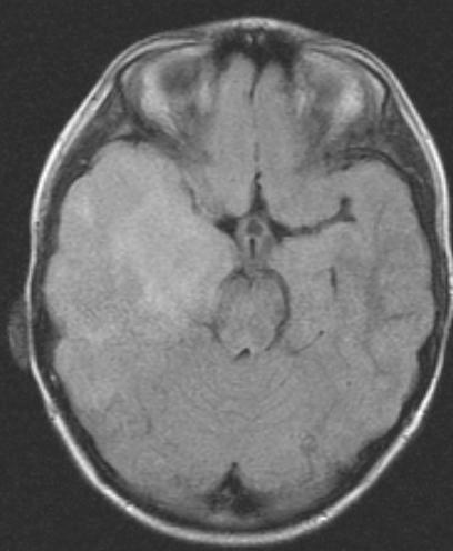 Astrocytoma of