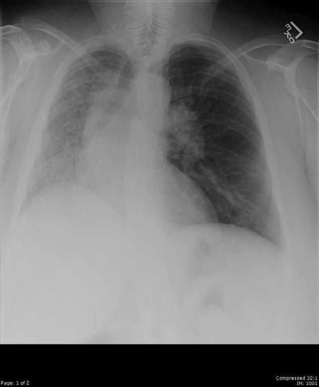 CHEST A 50-Year-Old Woman With Dyspnea, Lower Extremity Edema, and Volume Loss of the Right Hemithorax Eugene Shostak, MD; and Akmal Sarwar, MD, FCCP Postgraduate Education Corner PULMONARY AND