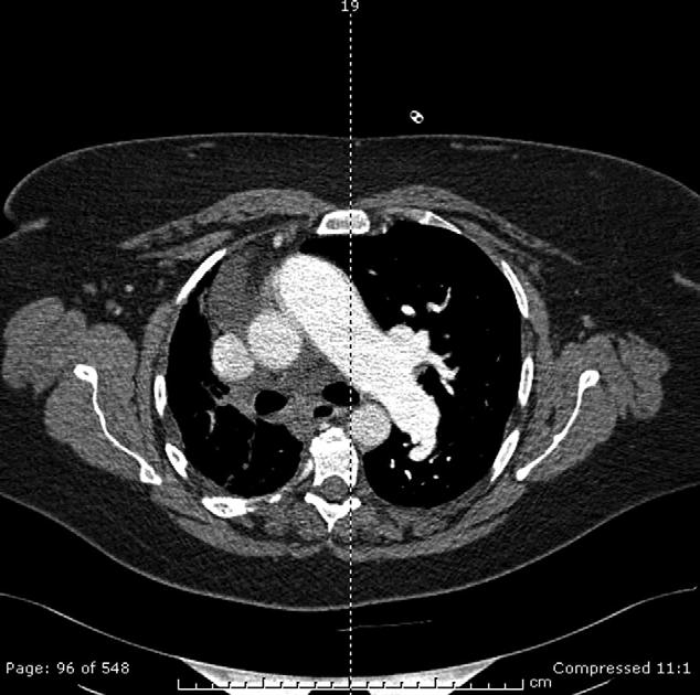 Figure 2. CT scan on hospital admission. were appreciated. An examination of her extremities was notable for 3 pitting edema halfway up to the knees.
