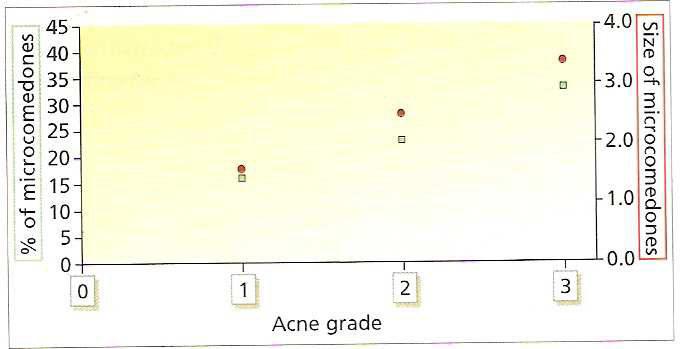 b) Moderate acne: several maculae and pustules nodules. c) Severe acne: numerous papules and nodules Figure1 Correlation between the number and size of microcomedones and acne severity.
