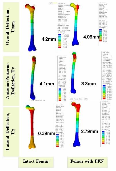 Figure 5. Deflection Comparison of Intact Femur and Fractured Femur with PFN implant Axial Strain Distribution The distribution of axial strain along the femoral axis is shown in the figure 6.