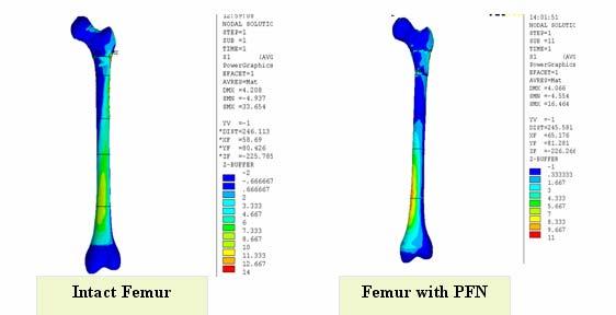 symmetrically for PFN implanted femur using the axial strain plot. ie., The PFN implant dominates in the motion control of the femur and implant assembly. Figure 6.