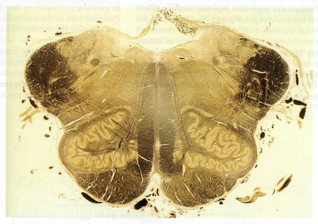 ROSTRAL (open) MEDULLA On the ventral aspect The pyramid is clear, with medial lemniscus on either sides of middle line dorsal to the pyramid Inferior Olivary