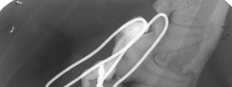 endodontic future is not certain and root canal treatment may be needed at further follow-up.