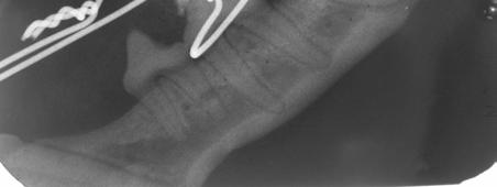 This molar had no long-term future, but its presence as anchor points for a splint made it a real asset at this