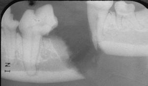 The distal portion of the first molar had good coronal surface area but the root was about to fall into the fracture