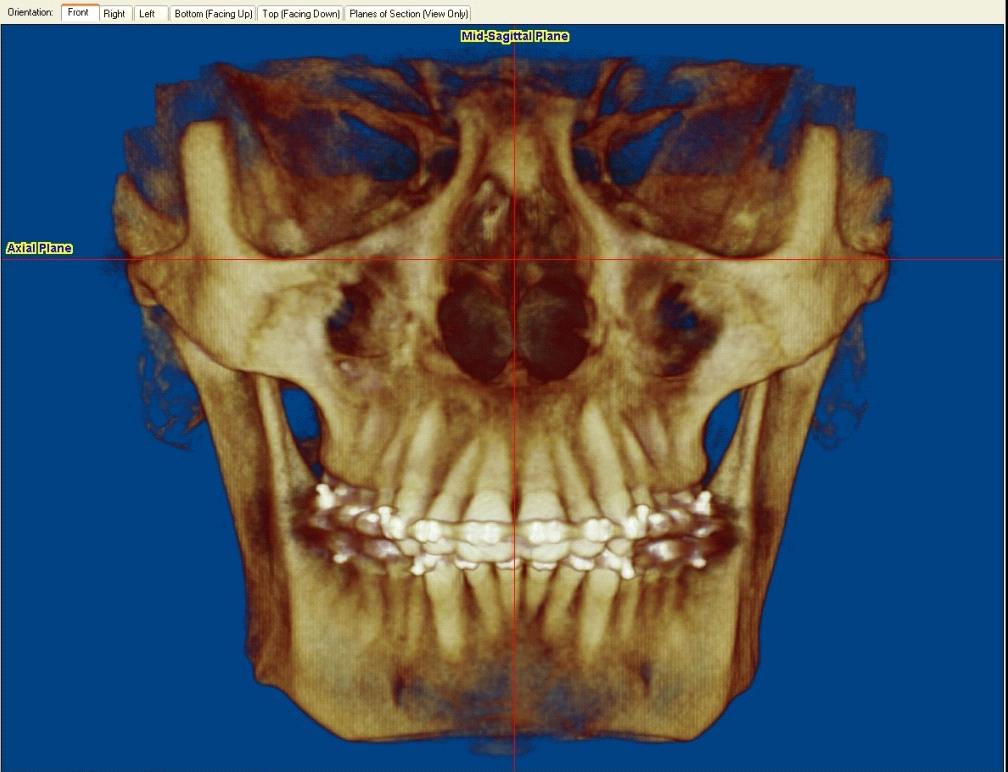 Figure 1. Frontal view of CBCT image for registration.