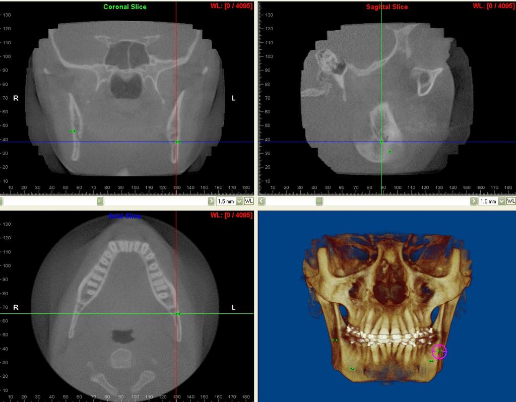 Figure 4. Measurements were made with the Coronal, Sagittal, Axial and a 3D projection of the CBCT data visualized simultaneously.