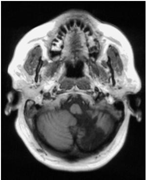 MRI makes dx. Usually occluded vertebral Basilar Ar