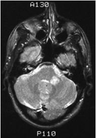 Multiple lesions distributed in time and space Multiple Sclerosis (MS) INO