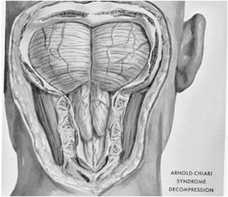 Chiari Malformation Treatment: Suboccipital decompression Non-otologic ataxias all of neurology? Arrow points to tonsils.