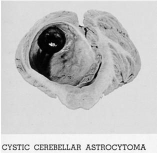 Cerebellar Astrocytoma Pontine Astrocytoma Largely in children Slowly growing tumor Cerebellar hemisphere