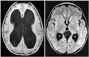 Diagnosis of MAV Nystagmus Diagnosis of MAV Clinical judgment No definitive pattern Often low amplitude downbeating or upbeating nystagmus, commonly present during positional testing.