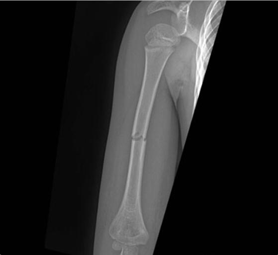 Supracondylar fracture Most common fracture of the elbow Mechanism of injury Fall onto outstretched hand Hyperextension